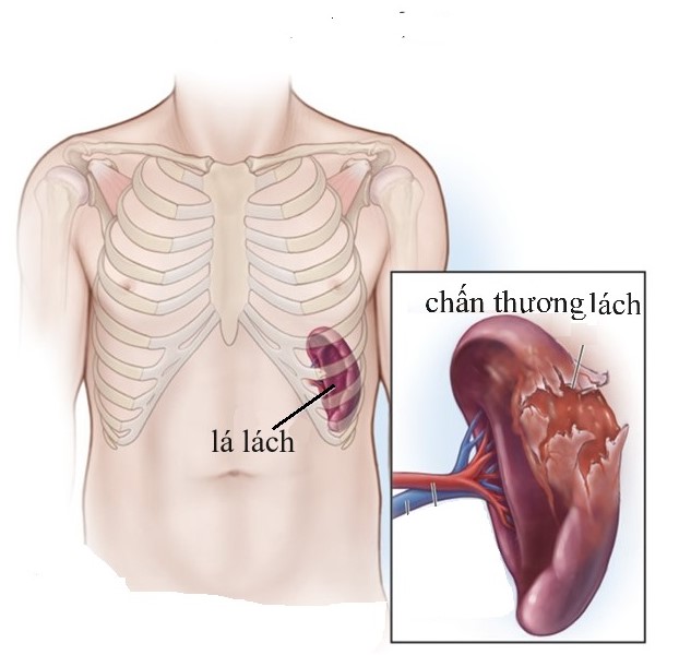 Thuốc và các phương pháp điều trị chấn thương lách