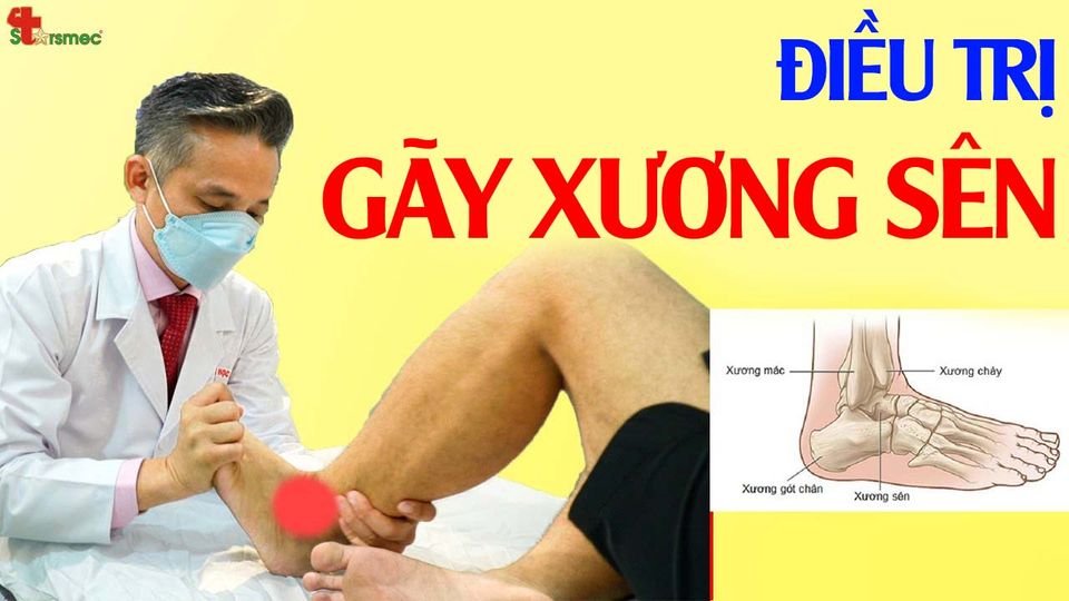 Gãy xương sên do lật cổ chân - Điều trị và chăm sóc thể nào?