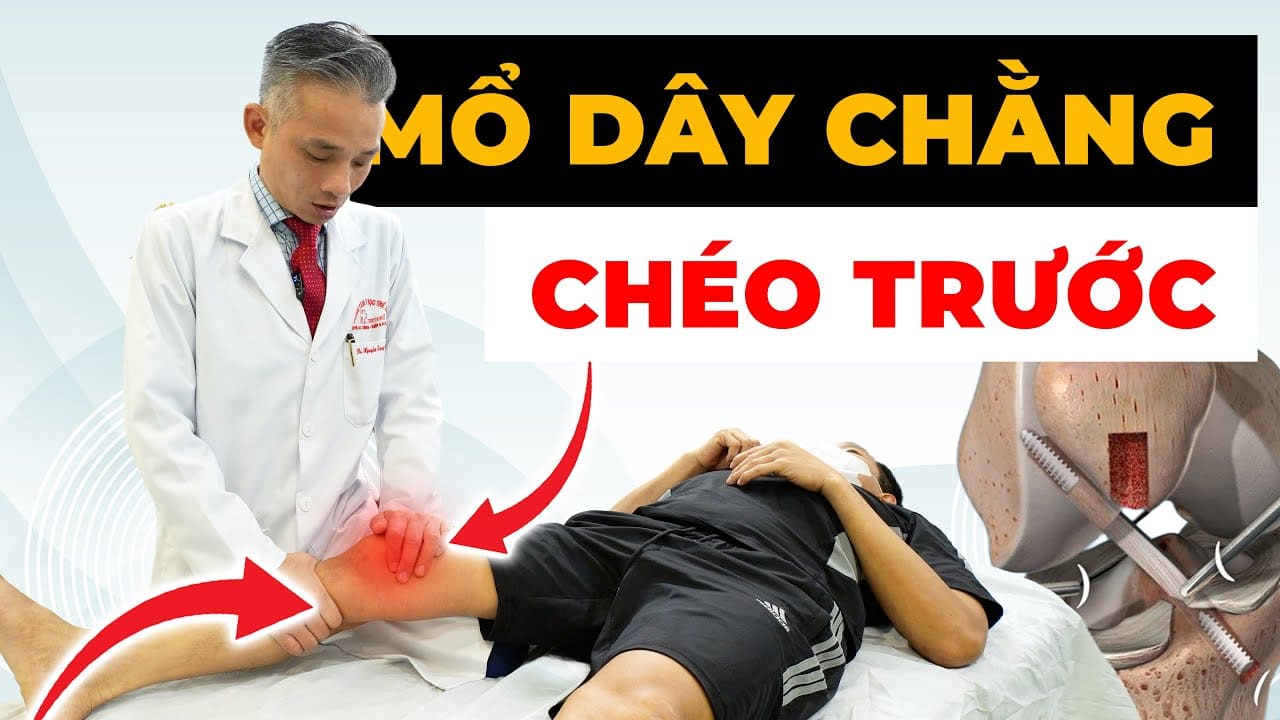 Phục hồi chức năng sau mổ DÂY CHẰNG CHÉO TRƯỚC ACL như thế nào?