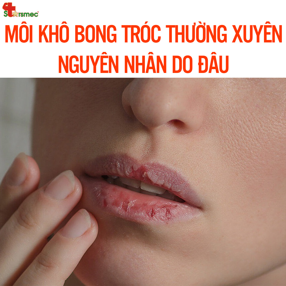 MÔI KHÔ BONG TRÓC dù dưỡng môi thường xuyên - Nguyên nhân do đâu?