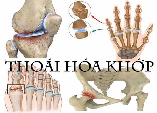 Thoái hóa khớp - Điều trị và chăm sóc thế nào?