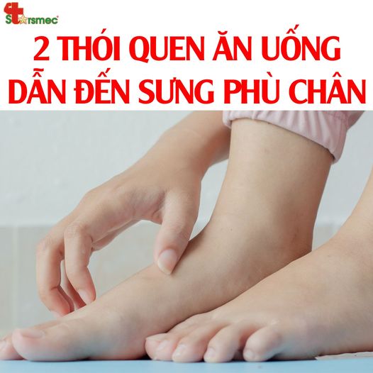 2 Thói quen ĂN UỐNG dẫn đến SƯNG PHÙ CHÂN