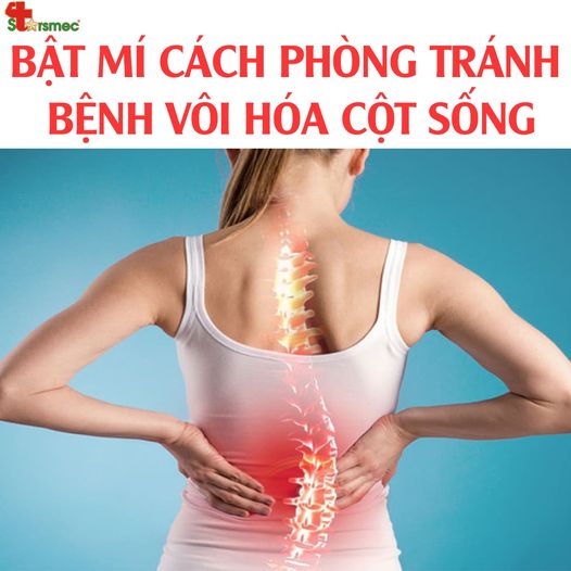 "Bật mí" cách phòng tránh bệnh lý vôi hóa cột sống