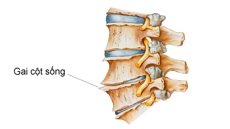Gai cột sống có nên tập thể dục không? Bác sĩ xương khớp hướng dẫn môn thể thao tốt cho cột sống