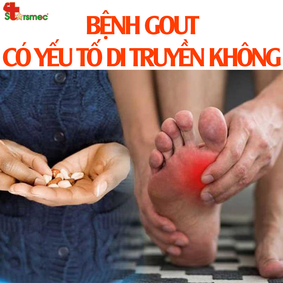 Bệnh GOUT có yếu tố DI TRUYỀN hay không?