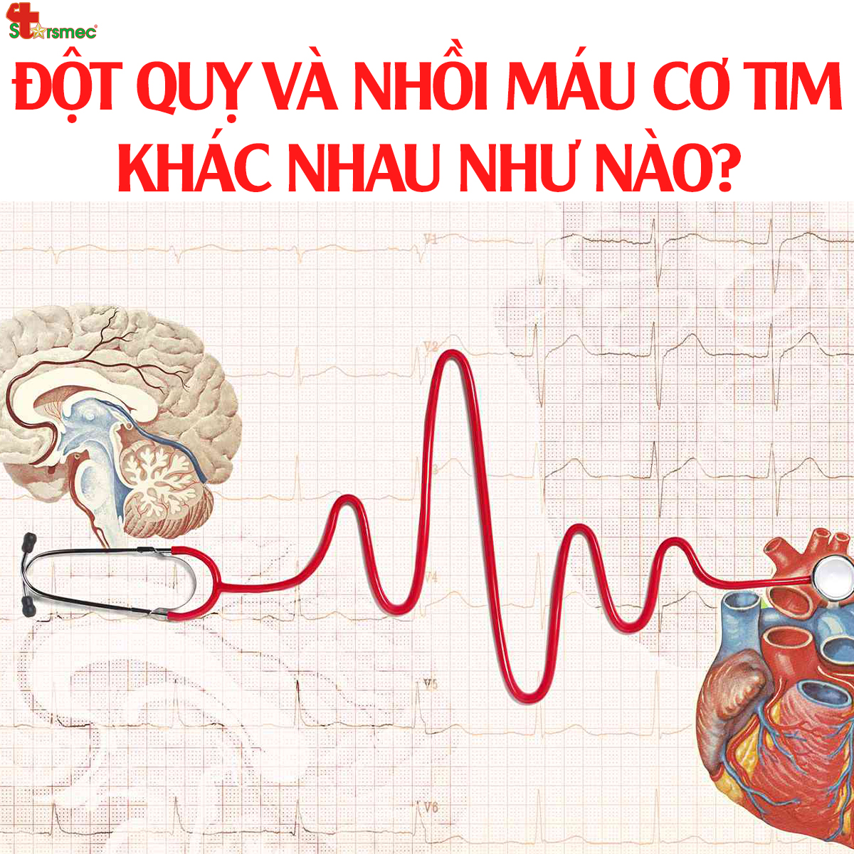 ĐỘT QUỴ và NHỒI MÁU CƠ TIM khác nhau như nào?